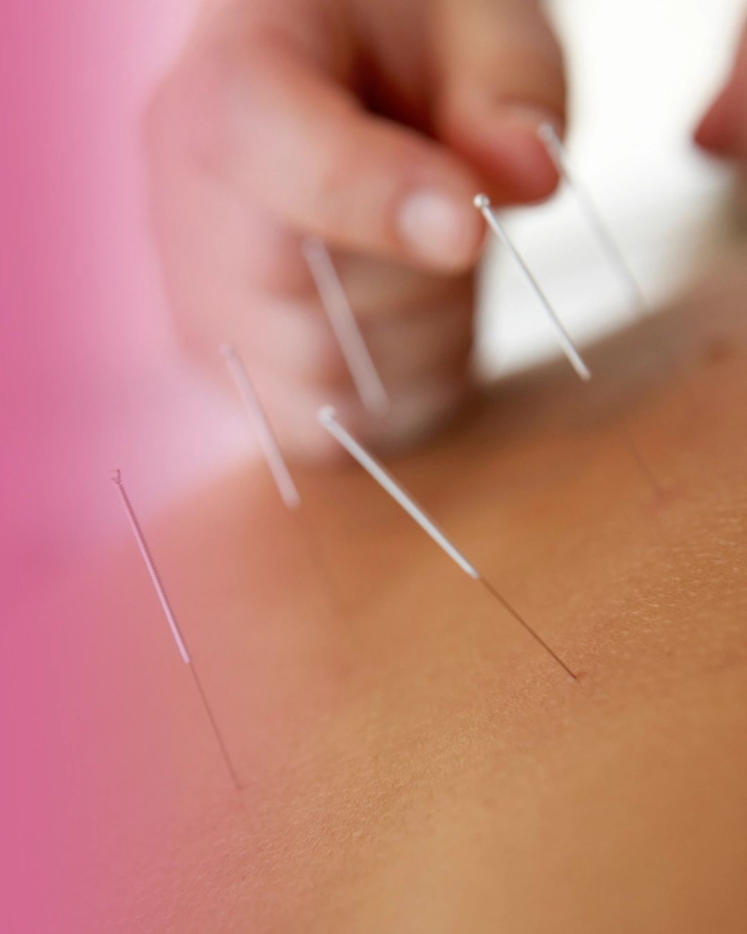 akupunktur-neuro-saarland